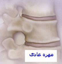 Osteoprosis2.JPG